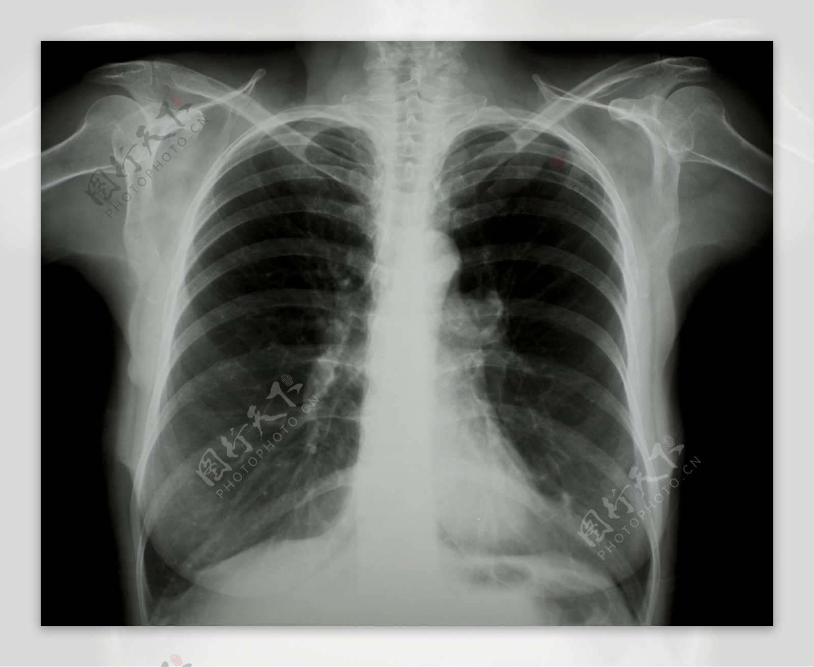 胸部X光片图片