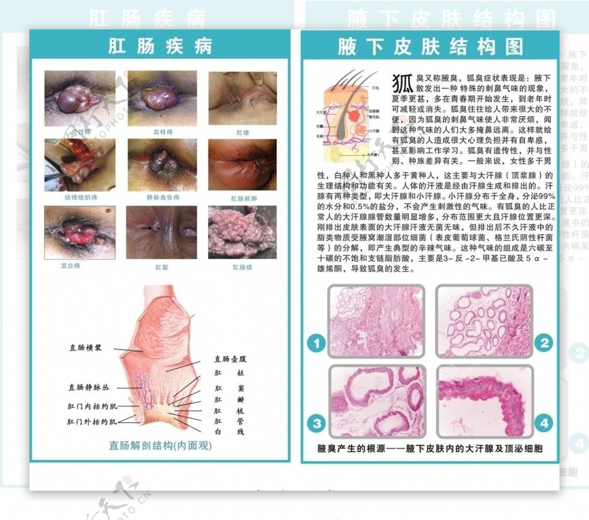 痔疮腋臭图图片