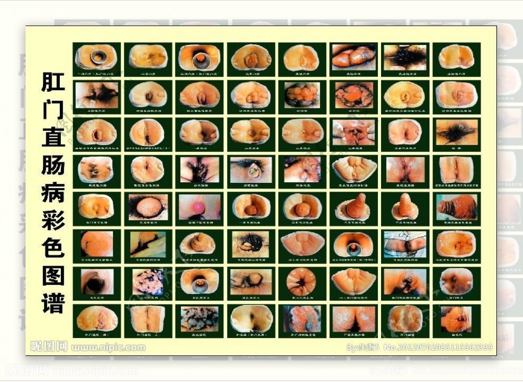 肛门直肠彩色图谱图片