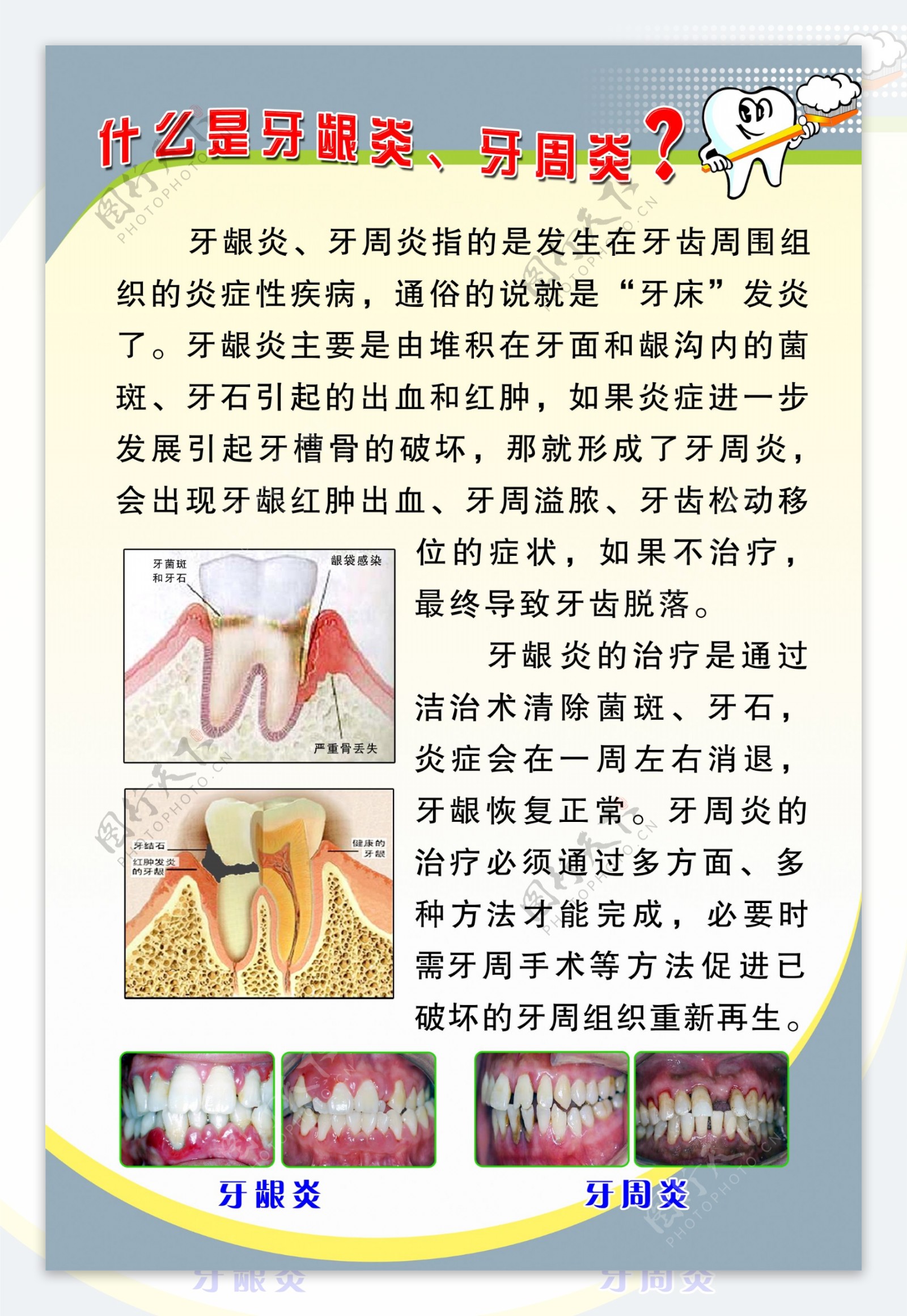什么是牙龈炎牙周炎图片