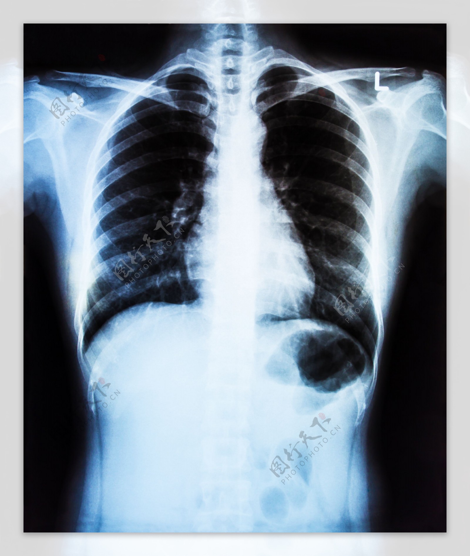 人体胸部X光片图片